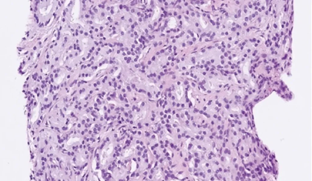 Prostatacancer med Gleasongrad 4