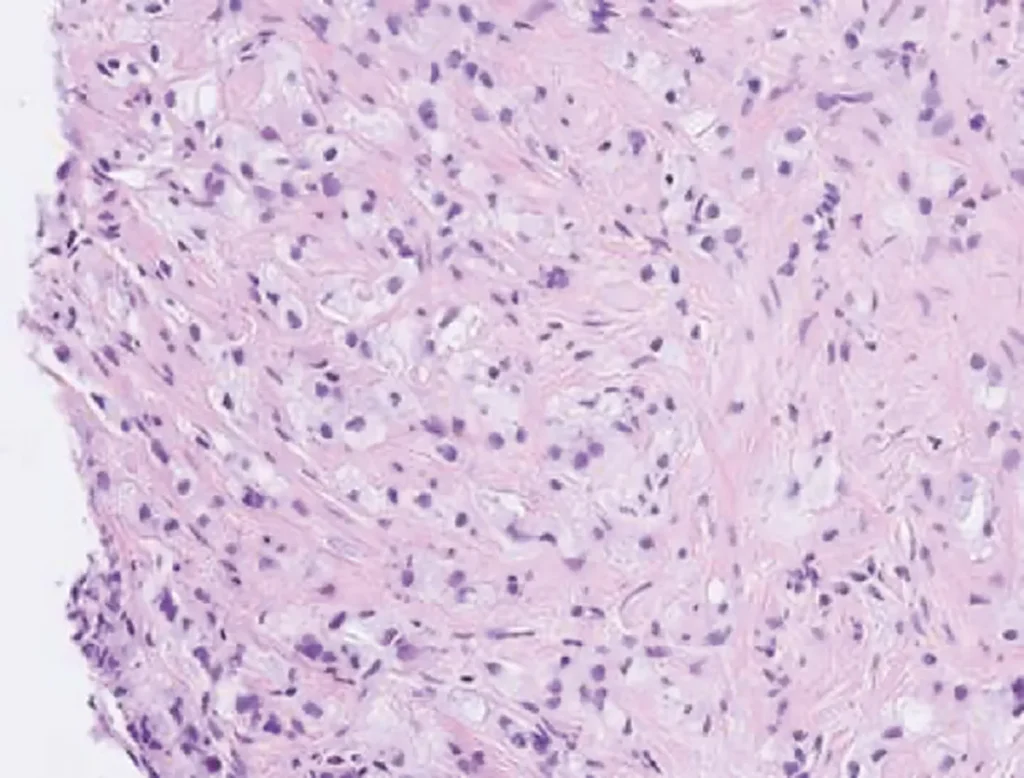 Prostatacancer med Gleasongrad 5. 